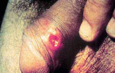 34 Figura 13 Lesão ulcerada (cancro-duro) característica de Sífilis primária. Fonte: http://www.dst.com.br/ Figura 14 Sífilis congênita. Fonte: http://www.dst.com.br/ 3.2.7.