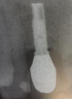 Critérios de Diagnóstico e Aproximação Terapêutica das Doenças Peri-Implantares Fig. 2: Imagem radiológica de uma lesão peri-implantar. Adaptado de Giovannoli e Renvert, 2012.