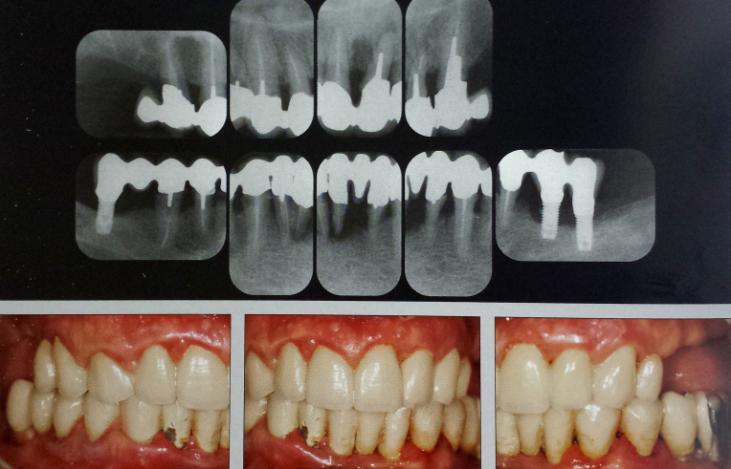 Critérios de Diagnóstico e Aproximação Terapêutica das Doenças Peri-Implantares implantar ou durante o acompanhamento) a prevalência da mucosite peri-implantar e da peri-implantite é de 64,6% e de