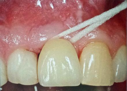 Os autores concluíram que não há associação entre a ausência de mucosa queratinizada e a presença de doença peri-implantar. 2.2.3.