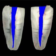 I (Sistema ProTaper), área de remanescente de