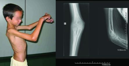 ARTRITE IDIOPÁTICA JUVENIL COM SINOVITE SECA Figura 1. Limitação para elevação de ombros, extensão de cotovelos e flexão de punhos e radiografia de cotovelo direito.