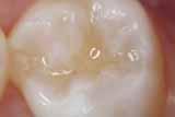 elevada resistência à abrasão elevada resistência à compressão baixo grau de contração Dente 27 após o selamento