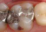 MATERIAIS DE RESTAURAÇÃO (COMPÓSITOS) x-tra fil Alfacomp LC Material de restauração fotopolimerizável para dentes posteriores Material fotopolimerizável para restaurações e núcleos de