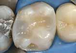 radiopacidade Compatível com qualquer adesivo de dentina / esmalte fotopolimerizável 1 2 3 No dente 26, a restauração de amálgama em mau estado deve ser substituída O brilho da superfície mostra