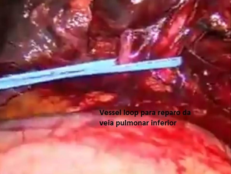 55 Aspectos táticos e técnicos observados nas ressecções pulmonares anatômicas por videotoracoscopia ou posterior.