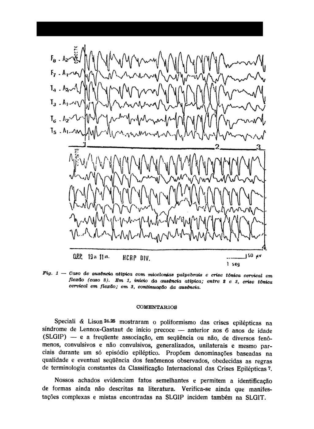COMENTÁRIOS Speciali <& Lison 2^25 mostraram o poliformismo das crises epilépticas na síndrome de Lennox-Gastaut de início precoce anterior aos 6 anos de idade (SLGIP) e a freqüente associação, em