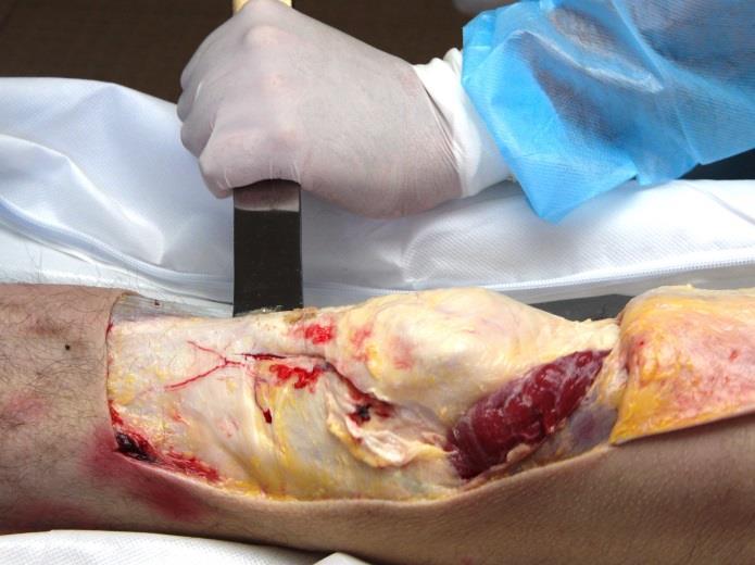 Figura 91 Separação do tendão patelar da sua inserção óssea na tíbia Figura 92 Remoção do tecido