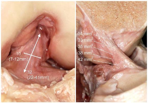 MEDIDA DA DEFORMAÇÃO DO LCA posteriormente, e paralela ao rebordo articular posterior do côndilo femoral externo. Esta área de inserção, menor que a da tíbia, tem cerca de 2 cm 2.