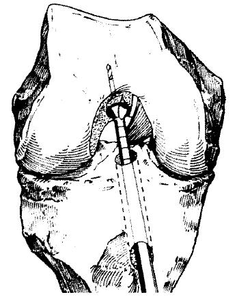 MEDIDA DA DEFORMAÇÃO DO LCA A técnica de uni-túnel proposta por Hendler evita a incisão na face externa do joelho, reduzindo a morbilidade, nomeadamente o risco de infeção (figura 49).