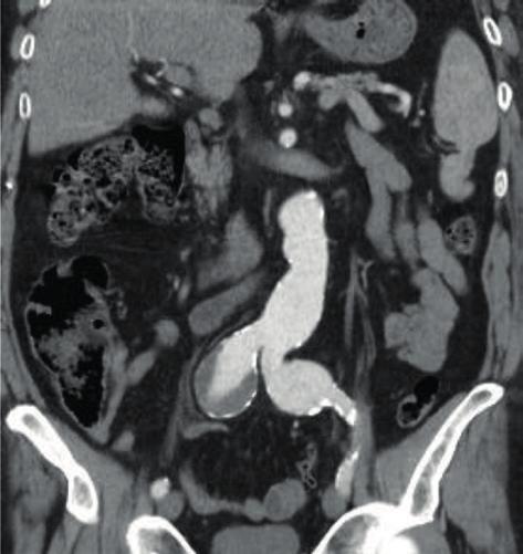 O stent coberto utilizado preferencialmente para selagem na artéria hipogástrica foi Atrium Advanta V12 Maquet na maioria dos casos (n=35, 88%).