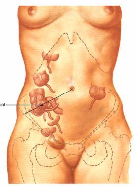 Obstrução do lúmem Infecção aguda do apêndice Trombose da A.