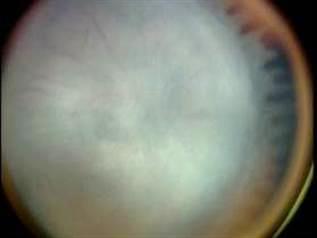 Estágio 5 - descolamento total da retina com formação de tecido fibroso ou