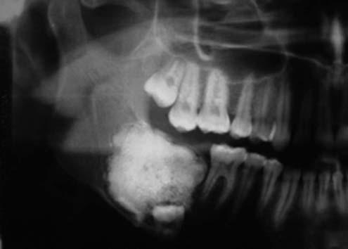 Um fino halo radiolúcido delimitava toda a lesão (Fig. 2 e 3). Diante dos aspectos clínicos e radiográficos, a hipótese diagnóstica foi de odontoma complexo.