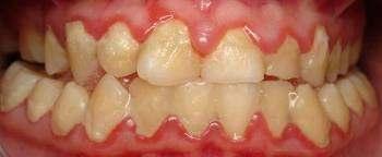 1.1. Cárie dentária: definição, epidemiologia e fisiopatologia A cárie dentária é uma doença pós-eruptiva, infecciosa e transmissível, relacionada com o tipo de dieta alimentar adoptada, levando à