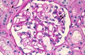 clofaziminas + corticóides) Proliferativa mesangial Droz e Lantz Malária