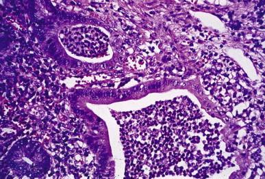 Microscopia: Infiltrado inflamatório crônico - mucosa e submucosa Neutrófilos: atividade da