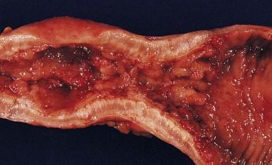 - Edema Espessamento - Fibrose da camada submucosa