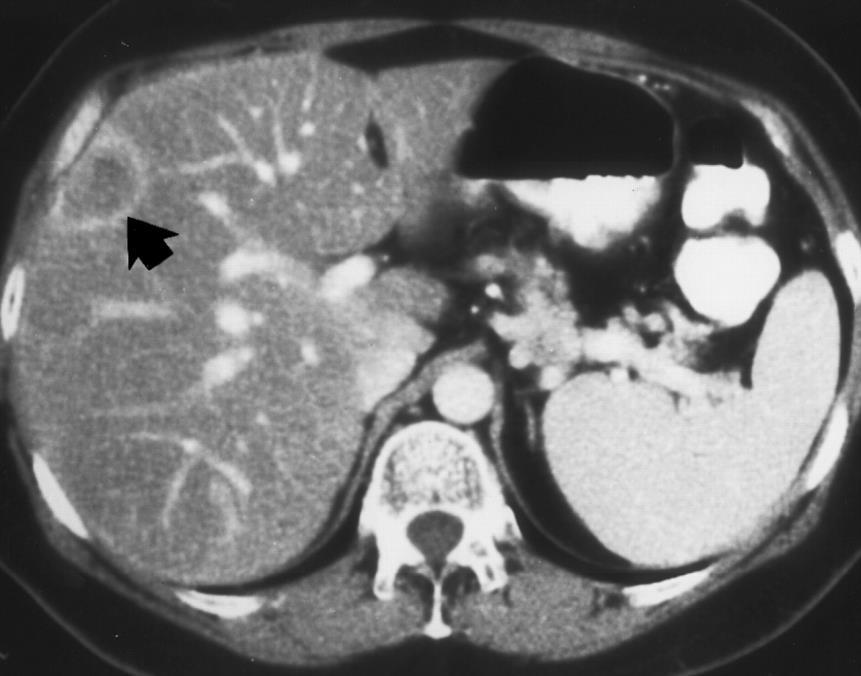 Achado típico: Lesão de comportamento hipovascular, mais evidente na fase portal, caracterizada por imagem