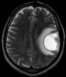 hiperintenso Edema (trauma, inflamação) Desorganização