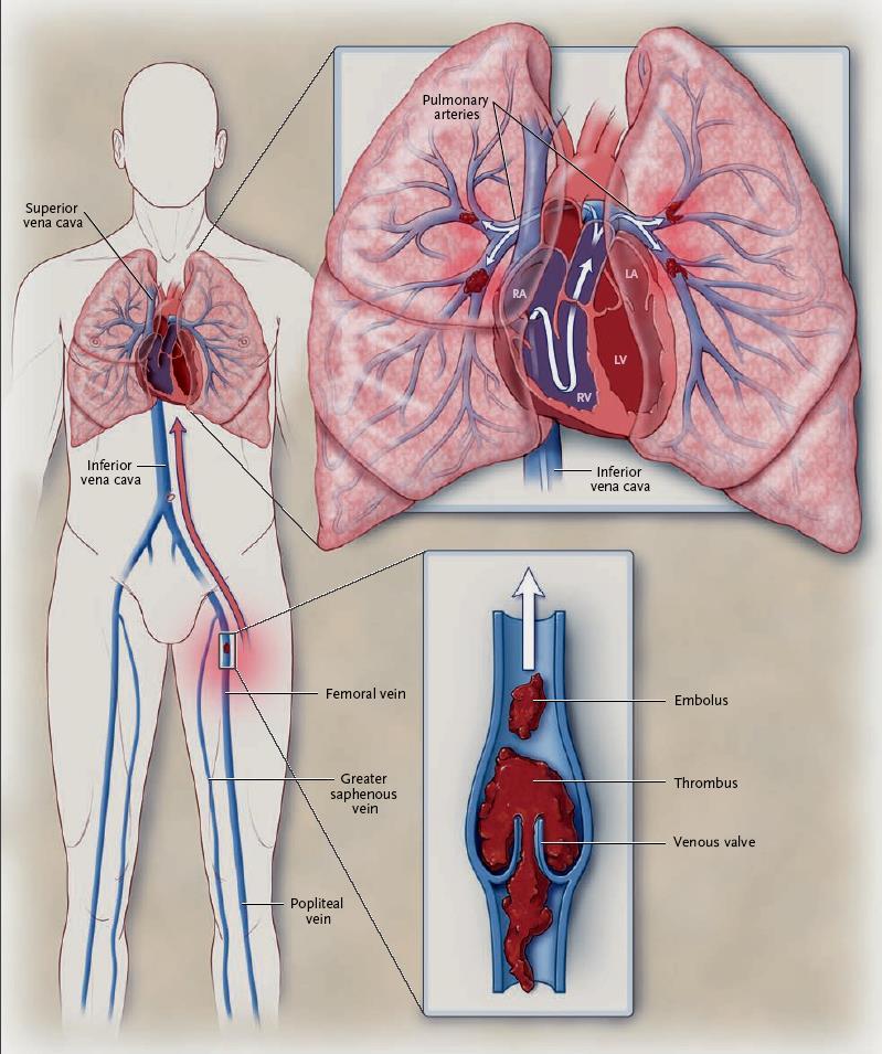 Tromboembolia Venosa Conceito Tromboembolia Venosa (TEV) Tromboembolia
