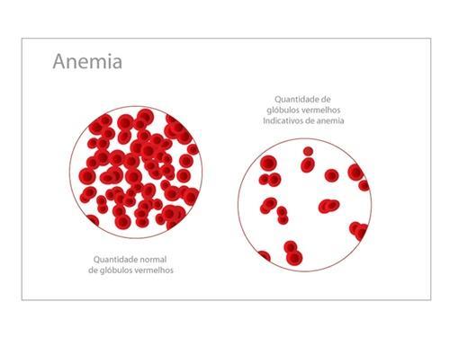 QUADRO CLÍNICO Formas atípicas Anemia ferropriva e