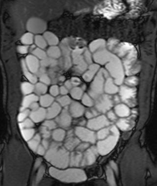 Fig1 - Imagens coronais T2 SSETSE (a) e steady state free precession (b) de um doente jovem com suspeita de doença de Crohn.