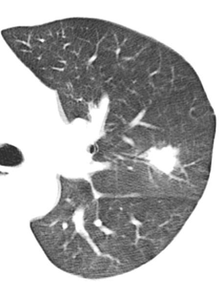 M, 36a. LLA em quimioterapia.