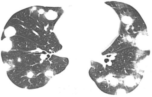 hemoptise.