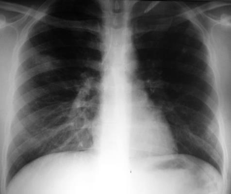 Pneumonia eosinofílica simples