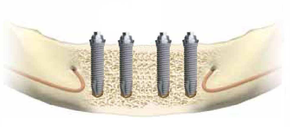 com 4 implantes, sendo os posteriores com inclinação de 30 ), conforme Figura 1. Sistema A A Sistema B B Figura 2 - configuração das barras protéticas sistemas A e B [7].