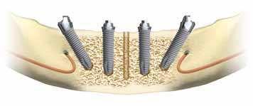 Os parâmetros dimensionais do conjunto protético (implante, pilar protético - reto e inclinado, parafuso do pilar, cilindro protético e parafuso protético) foram baseados no implante do tipo