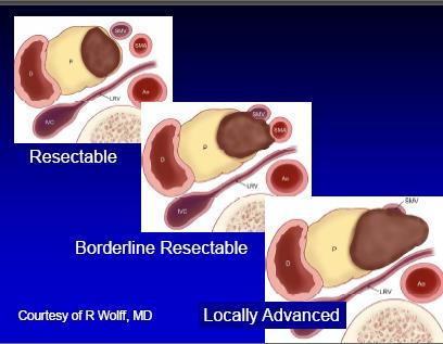 Cancro do pâncreas - tumor borderline: Diferentes definições American Hepato-Pancreato-Biliary Association (AHPBA) the Society for Surgery of the Alimentary Tract (SSAT) and the Society for Surgical