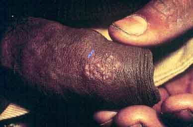 Herpes Genital Lesões vesiculosas em pênis: