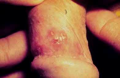Herpes Genital Lesões exulceradas em pênis: bordas hiperemiadas.