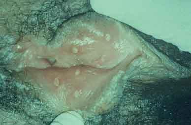 Herpes Genital Lesões exulceradas em pequenos lábios: lesões exulceradas em face interna de pequenos lábios