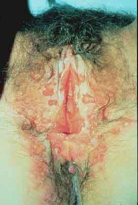 Herpes Genital Extensa vulvite herpética: a primo-infecção do Herpes Genital é, geralmente, mais intensa que as recorrências.