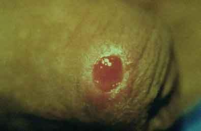 Sífilis Recente (primária) - Cancro duro Úlcera em pênis: lesão única bem definida, fundo limpo.
