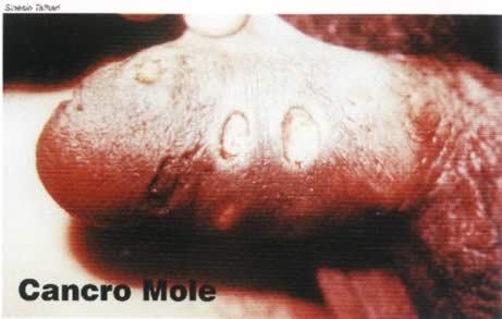 Cancro Mole Úlceras