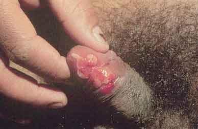 Donovanose ou Granuloma Inguinal Úlcera em