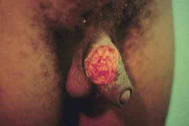 Donovanose ou Granuloma Inguinal Extensa úlcera em pênis: extensa