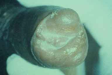 Uretrite gonocócica aguda e Balanopostite Secreção uretral: edema de prepúcio.