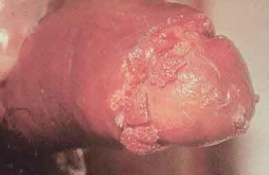 Condiloma Acuminado Lesões vegetantes verrucosas em pênis: observar que as