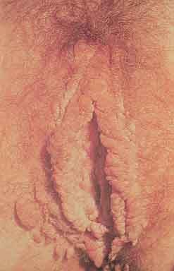 Condiloma Acuminado Lesões vegetantes em vulva: é fundamental examinar toda a área