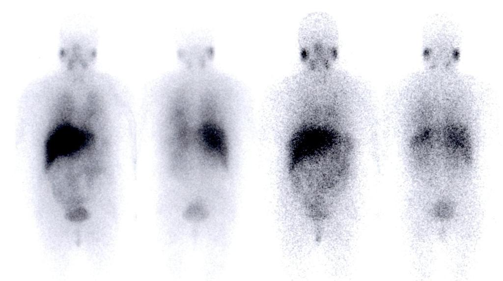 Hosp. Santa Marta INTERNAMENTO EXAMES COMPLEMENTARES DIAGNÓSTICO (3) Cintigrafia Corporal 123 I-MBG