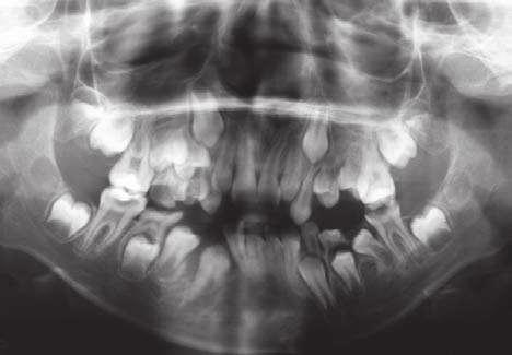 Em decorrência da relação maxilar alterada, o eixo facial estava diminuído e o plano mandibular e a altura facial inferior estavam aumentados, caracterizando uma rotação horária da mandíbula.