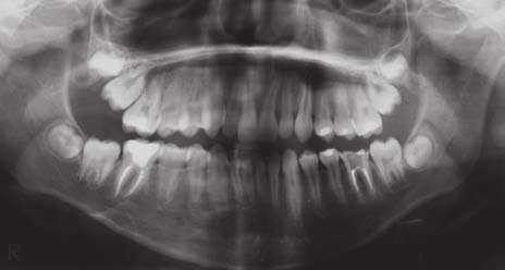 tratamento mais complexo 29, 36. Além do diagnóstico de MAA, neste caso foi identificada uma relação molar de classe II de Angle e padrão de crescimento facial hiperdivergente.