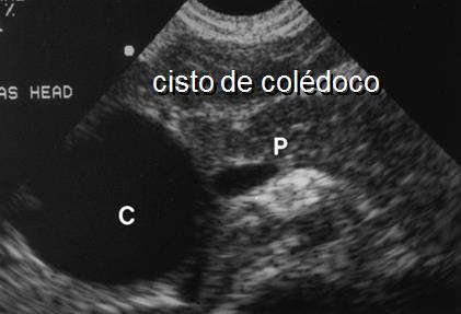 CISTO DE COLÉDOCO Segunda causa cirúrgica mais comum de CN Apresentação é AVBEH suspeitar em colestase de início súbito ou colangite Massa