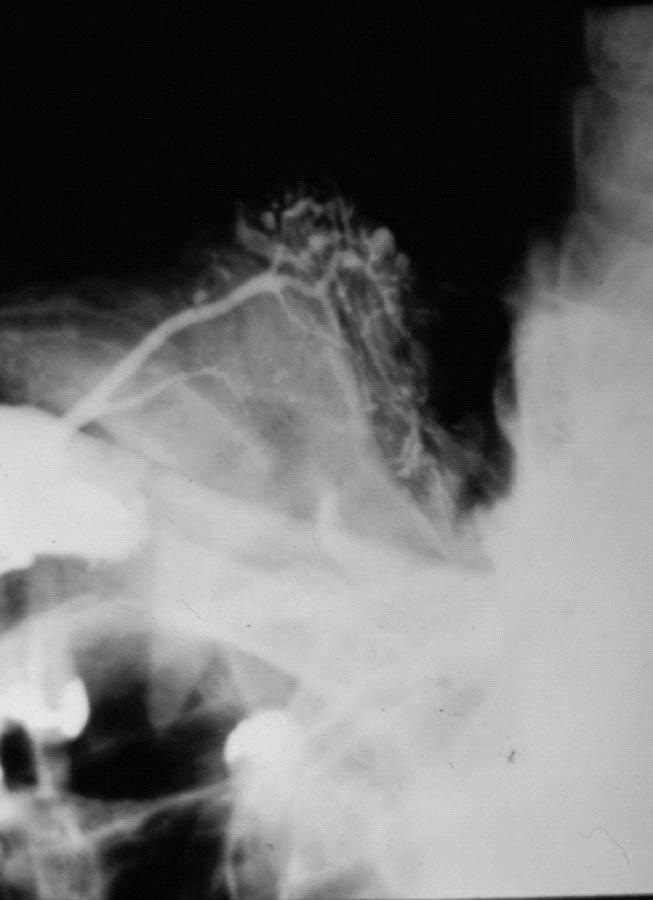 3) Espessamento do ducto com aspecto de "árvore sem folhas" Figura 4 - Sialografia de glândula parótida: demonstra pequenas áreas de obstrução no ducto parotídeo Figura 1 - Radiografia oclusal