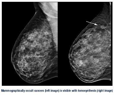 Breast tomosynthesis Eficiência Quântica na Detecção (DQE) em TMD Dose glandular Média (DGM) para tomossíntese é esperada ser da mesma ordem daquela para mamografia